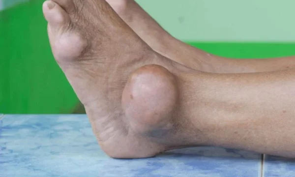 5 Tanda Awal Gambar Kaki Asam Urat Ini Wajib Anda Waspadai di 2026 Sebelum Terlambat